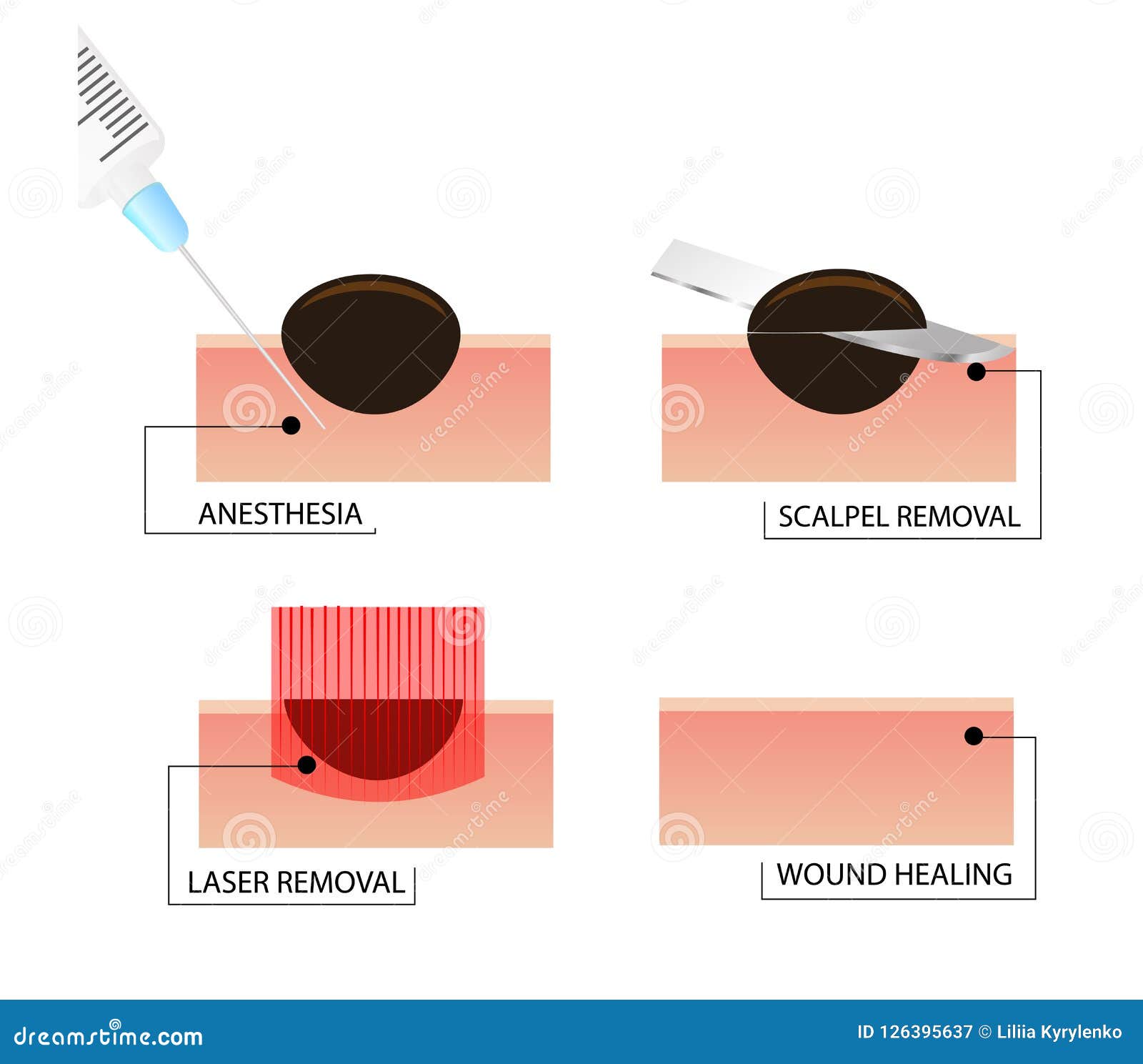 Illustrative image for best way to exterminate moles