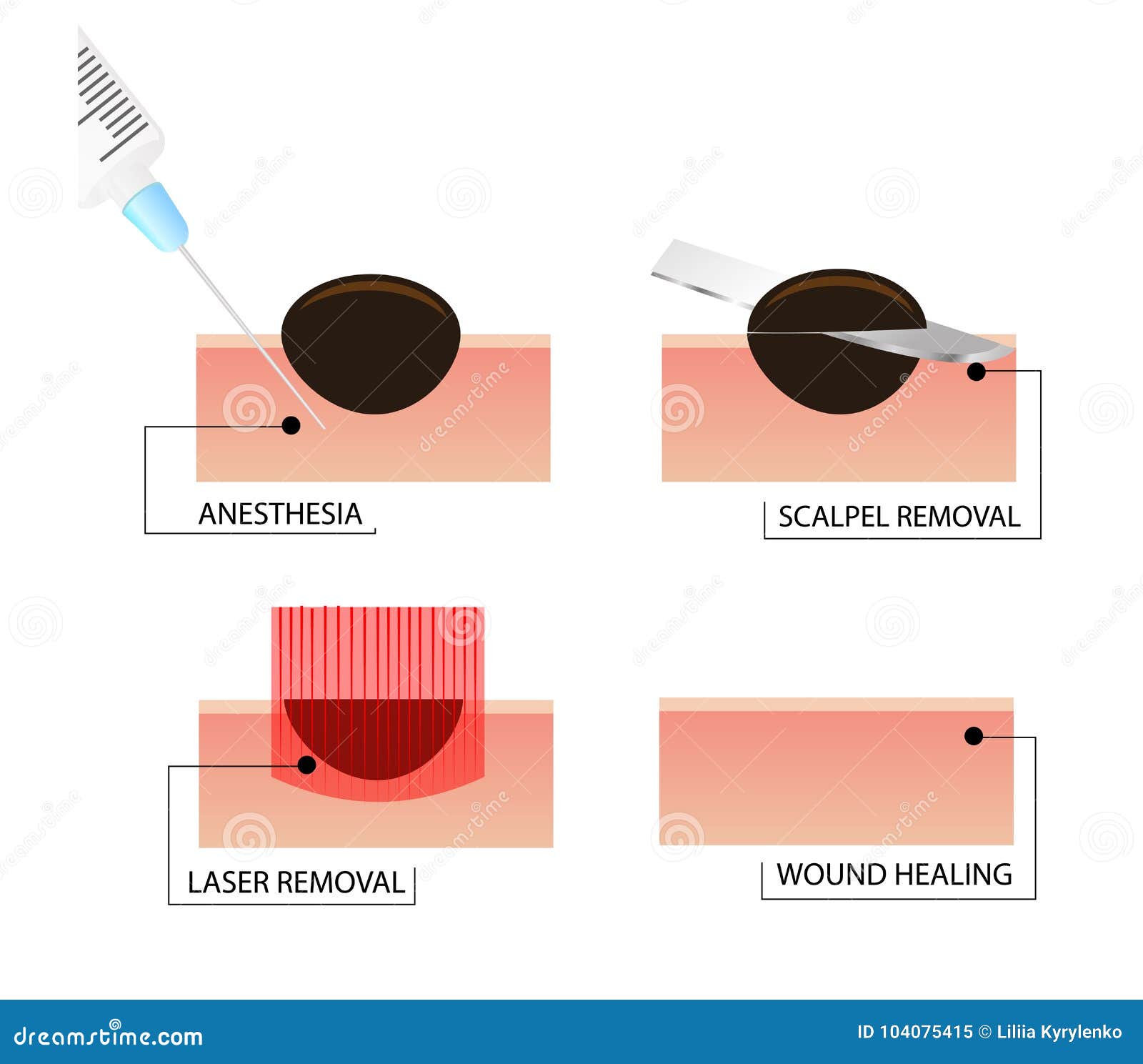 Illustrative image for best way to kill moles